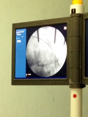 This surgeon is good! What you see is a side view of SIX perfectly aligned screws.